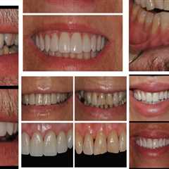 Transform Your Smile: How Veneer Dentistry And Orthodontics Can Enhance Your Oral Aesthetics In..