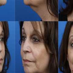 Why Health Consultants Recommend SMAS Facelift For Facial Rejuvenation In NY