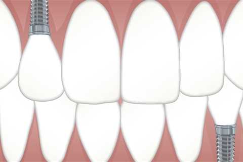 Restore Your Smile with Dental Implant Surgery in North Little Rock