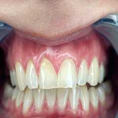 Prioritize Dental Safety When Considering Teeth Whitening Costs in Ottawa