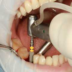 From Dental Hygienists to Guided Implant Surgery: A Path to Lasting Smiles in North Little Rock, AR