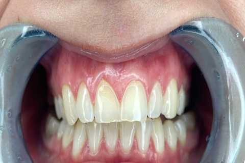 Prioritize Dental Safety When Considering Teeth Whitening Costs in Ottawa